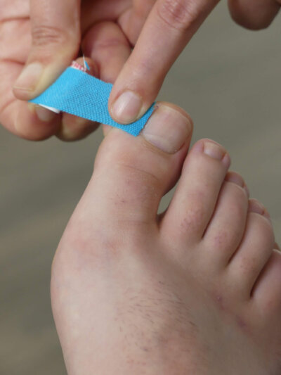 足の巻き爪は切り方が原因 治療から対策までシンプルに解説 H2株式会社
